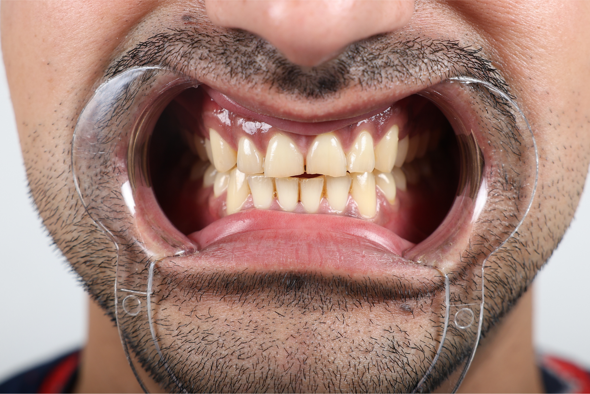 Before E-max Veneer Treatment